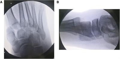 Staged surgery for closed Lisfranc injury with dislocation